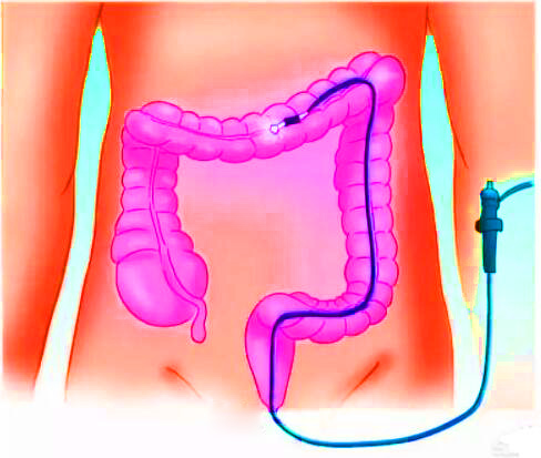 直腸癌早期有哪些癥狀？